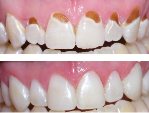 curaciones dentales esteticas